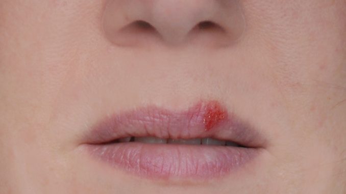 Herpes simplex, Lippenbläschen und sonstige Viren