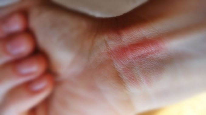 Verbrennung_Handgelenk2_xs Eliane Zimmermann AiDA Aromatherapy