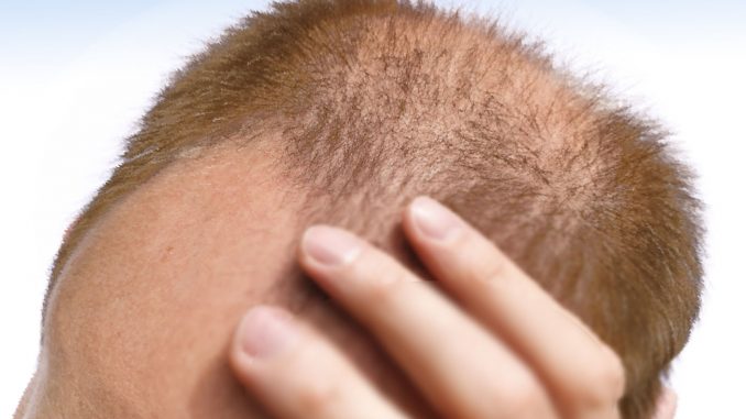 Alopecia